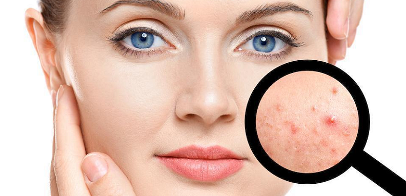 acne preventative measures