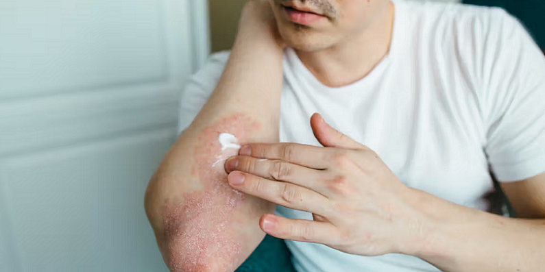 eczema skincare routines
