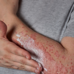 psoriasis skincare routine flaky skin
