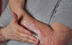 psoriasis skincare routine flaky skin